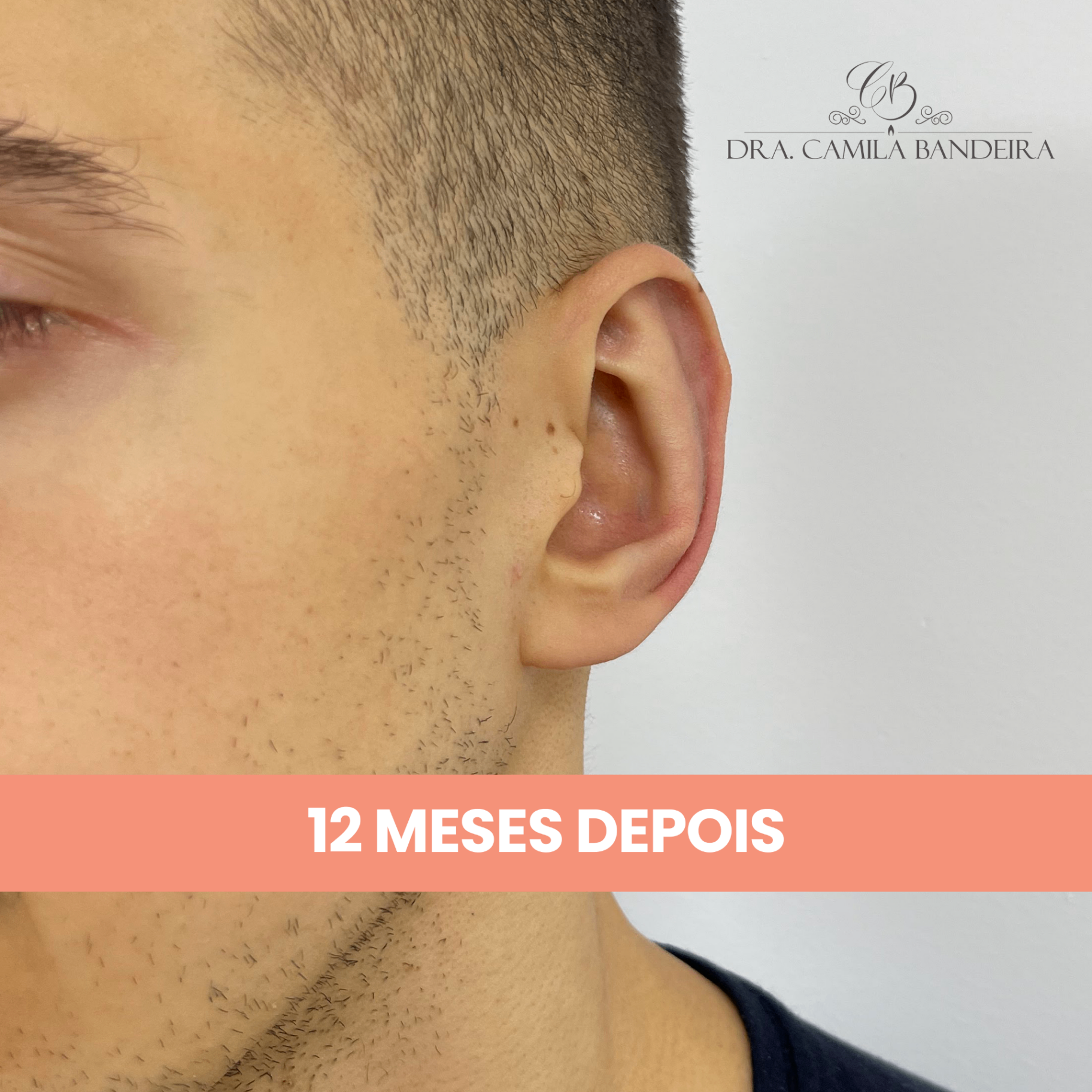 Etapa 3 do procedimento